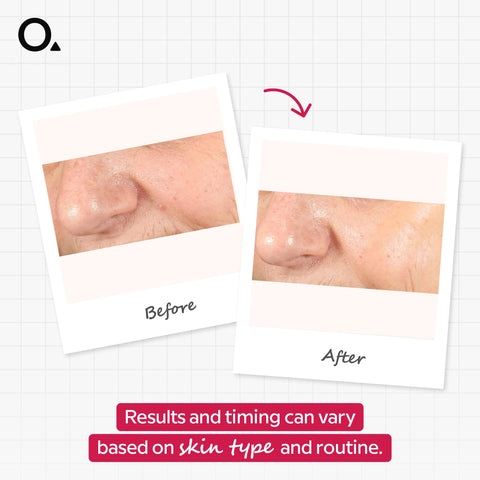 AHA 30% + BHA 2% Peeling Solution