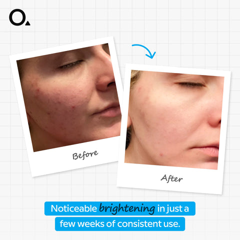 Ascorbic Acid 8% + Alpha Arbutin 2%